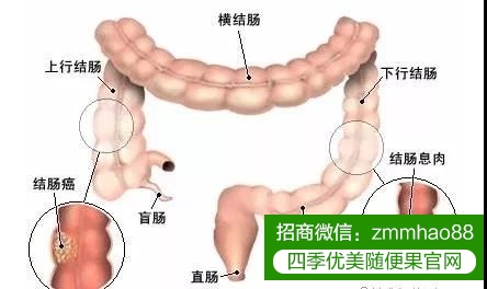 肠道的那些事你知多少？你需要警惕这些症状！